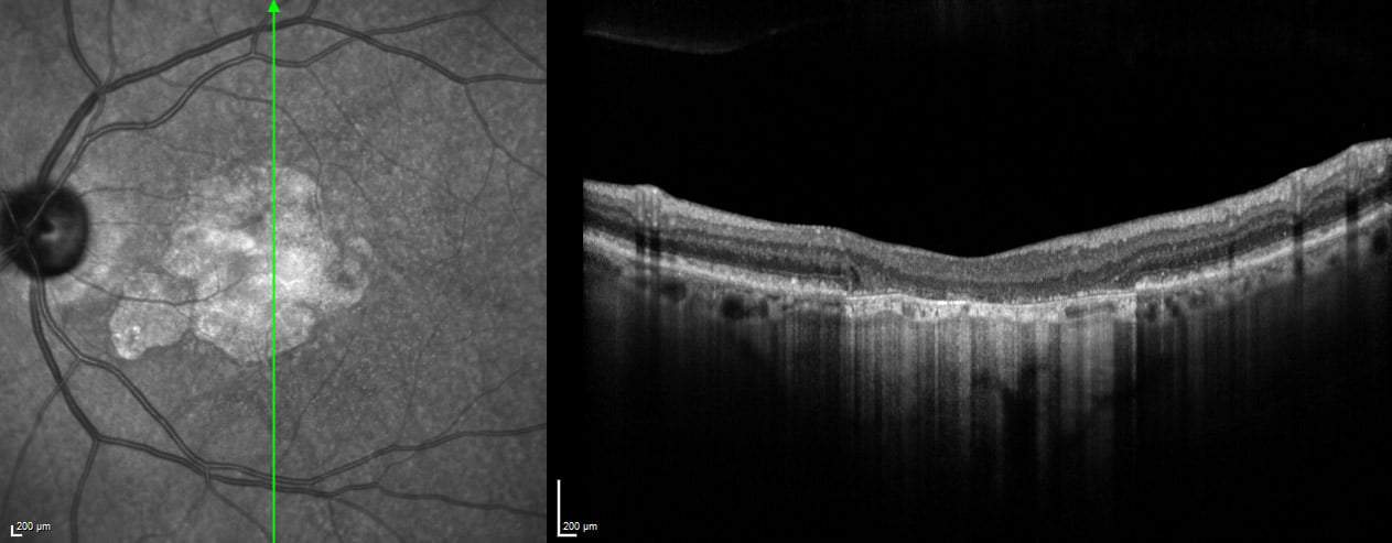 Dry Age Related Macular Degeneration - Foundation For Vision Research